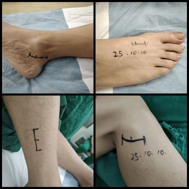 脑外科成功开展周围神经减压术，为糖尿病患者解除病痛困扰