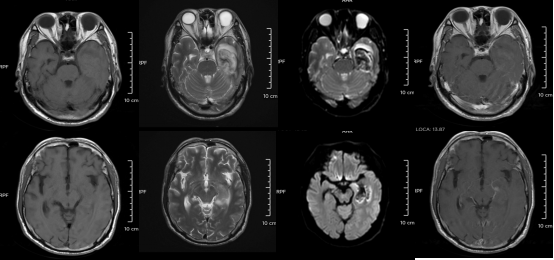 30岁小伙长期熬夜智力退回3岁 年轻人患“脑膜炎”病例为何频发？