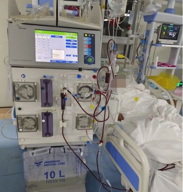 重症脓毒血症患者急性肾衰竭，床旁血液净化技术成功救治