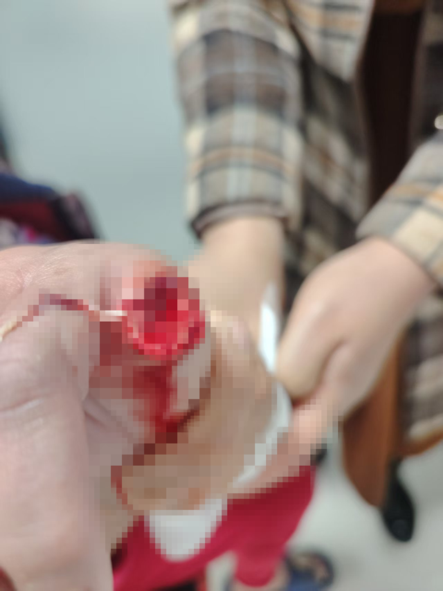 自家宠物犬突然发狂咬断主人手指 专家提醒犬伤处置切勿拖延