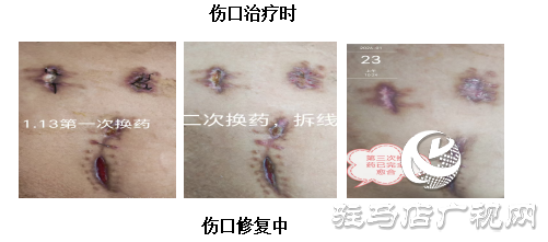 【新技术】PRF自体修复技术唤醒伤口自愈力 快愈无痕更舒心