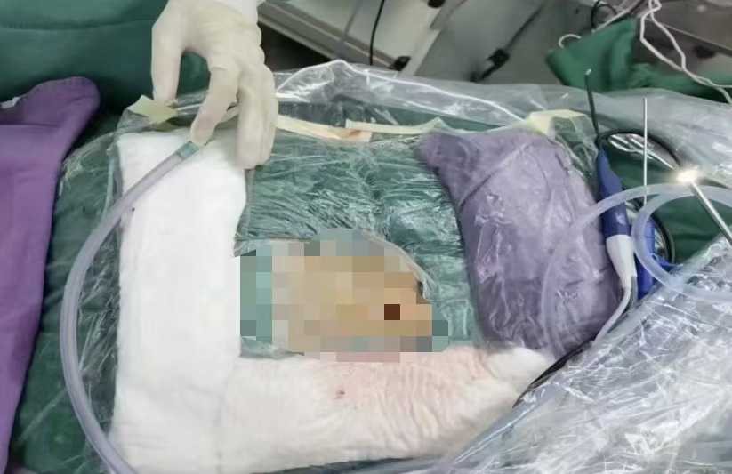 驻马店市中医院成功实施UBE微创手术，助腰腿痛患者重获健康