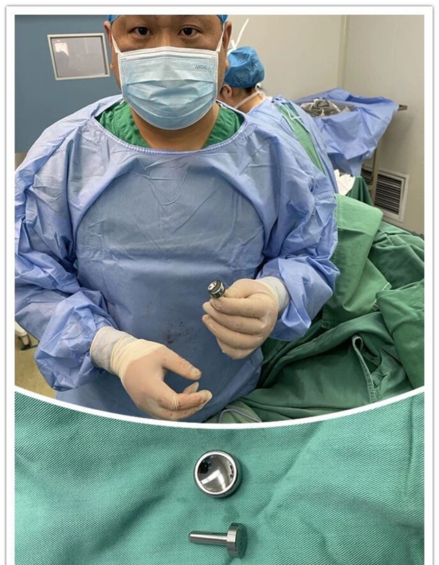 驻马店市中医院成功开展首例人工桡骨头置换术