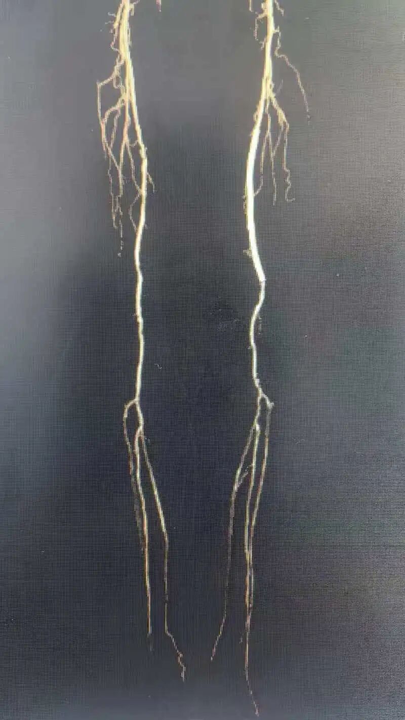 低温危机！七旬老人脚部溃烂无法行走竟因这个病