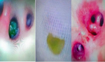 险！葡萄果肉堵塞气道，驻马店市中医院儿科上演镜下 “拆弹”