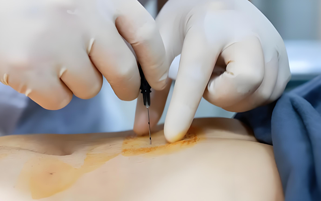 减肥总反弹？那是身体在“报警”！中医埋线：不折腾、不挨饿，先把你的易胖体质调回来