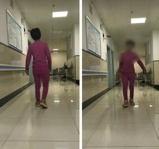 假体松动不用愁！髋关节翻修术为患者重启稳固人生