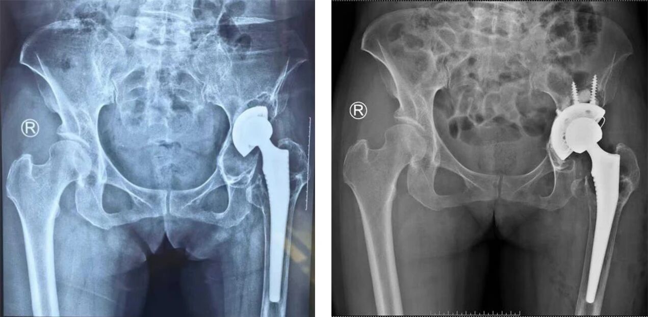 假体松动不用愁！髋关节翻修术为患者重启稳固人生