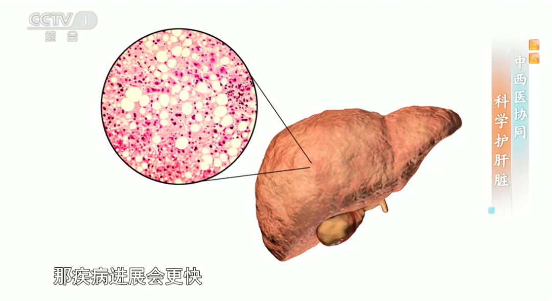 研究发现：45岁前患上脂肪肝的人，多年后更易得癌
