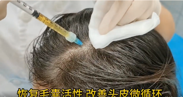 脱发年轻化，CGF自体再生疗法带来新希望