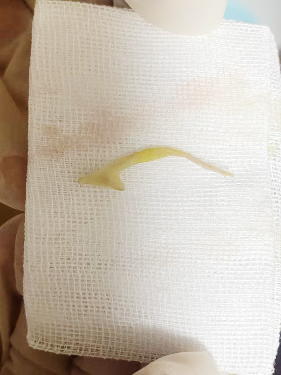 吓懵！胃痛竟是因为一根鸡骨头！一颗 “小胶囊” 精准揪出胃痛元凶